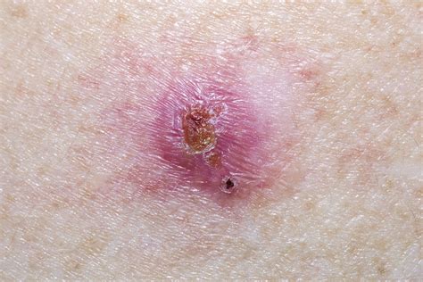 basaalcelcarcinoom dior plaspillen|Treating Basal Cell Carcinoma .